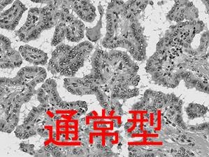 通常型甲状腺乳頭癌 組織像 通常型甲状腺乳頭癌 組織像
