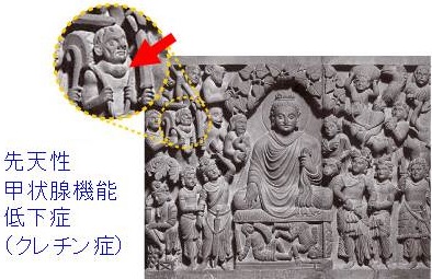 ガンダーラ地方の仏陀の彫刻「大きな甲状腺腫と愚人顔貌、太鼓を背負った小柄な人」先天性甲状腺機能低下症(クレチン症)の典型像 ガンダーラ地方の仏陀の彫刻「大きな甲状腺腫と愚人顔貌、太鼓を背負った小柄な人」先天性甲状腺機能低下症(クレチン症)の典型像