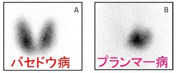 プランマー病 プランマー病