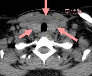 甲状腺のCT画像 甲状腺のCT画像