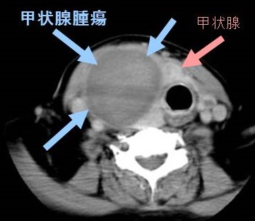 甲状腺 CT画像2 甲状腺 CT画像2