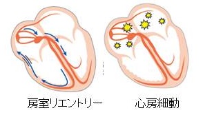 WPW症候群 房室回帰性リエントリー WPW症候群 房室回帰性リエントリー
