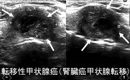 転移性甲状腺癌(腎臓癌甲状腺転移) 転移性甲状腺癌(腎臓癌甲状腺転移)