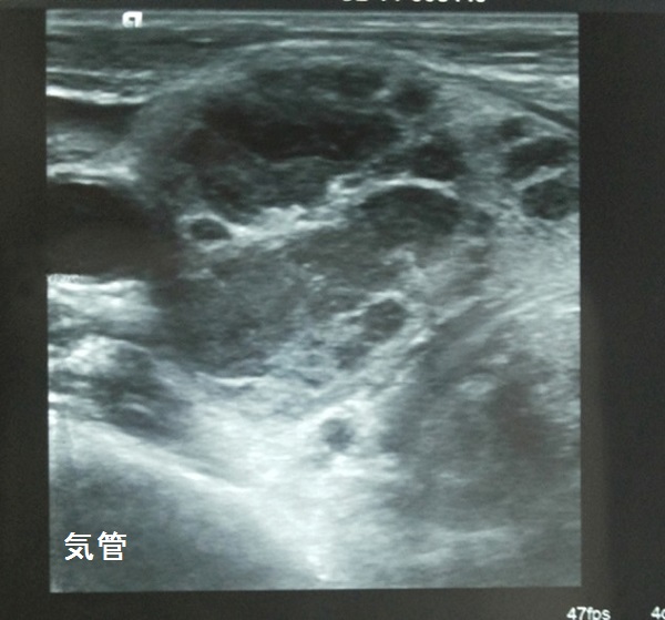 甲状腺結核 超音波(エコー)画像 甲状腺結核 超音波(エコー)画像