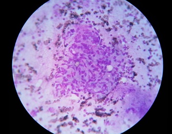 甲状腺結核 類上皮肉芽腫 甲状腺結核 類上皮肉芽腫