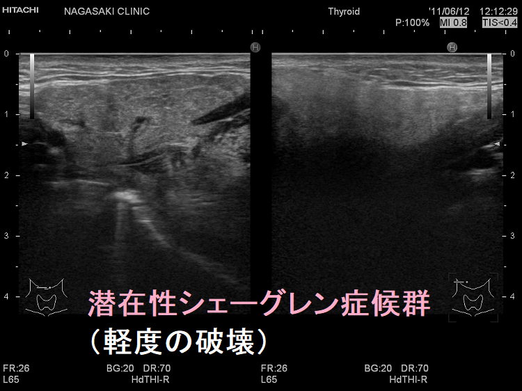 潜在性シェーグレン症候群(軽度の破壊)超音波(エコー)画像 潜在性シェーグレン症候群(軽度の破壊)超音波(エコー)画像