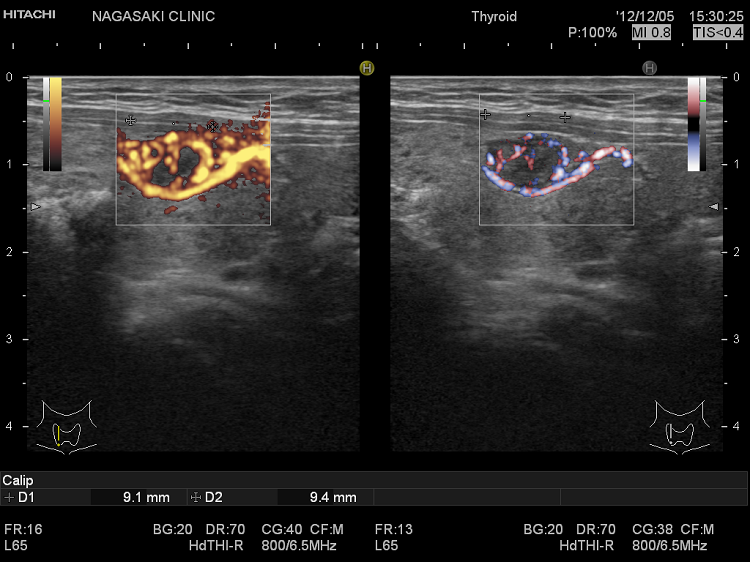 腹腔鏡下スリーブ状胃切除術 腹腔鏡下スリーブ状胃切除術