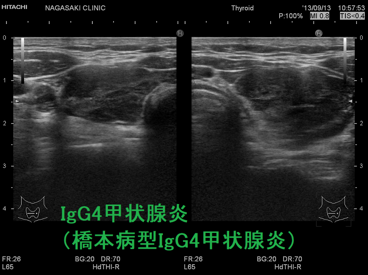 IgG4甲状腺炎(橋本病型IgG4甲状腺炎) 超音波(エコー)画像 IgG4甲状腺炎(橋本病型IgG4甲状腺炎) 超音波(エコー)画像