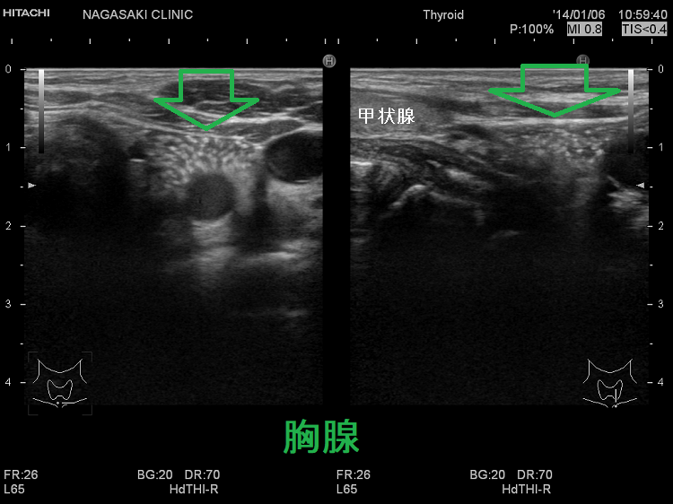 小児甲状腺乳頭癌のように見える胸腺 超音波(エコー)画像 小児甲状腺乳頭癌のように見える胸腺 超音波(エコー)画像