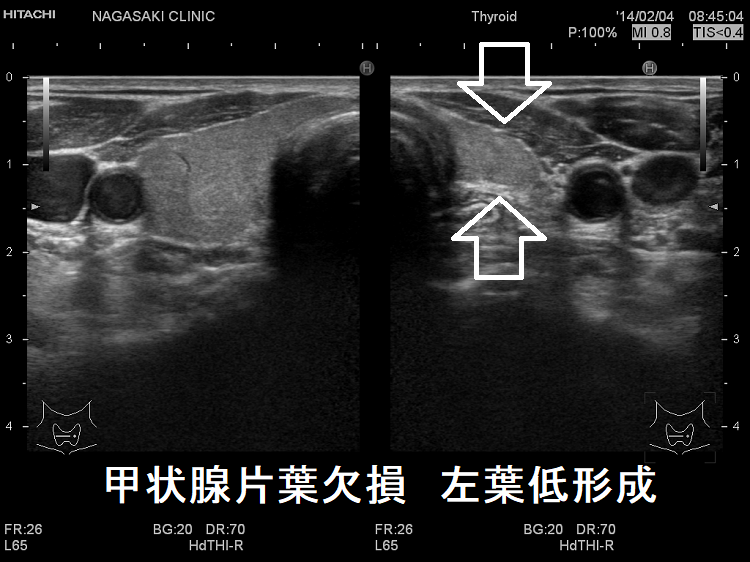 甲状腺片葉欠損症 超音波(エコー)画像 甲状腺片葉欠損症 超音波(エコー)画像