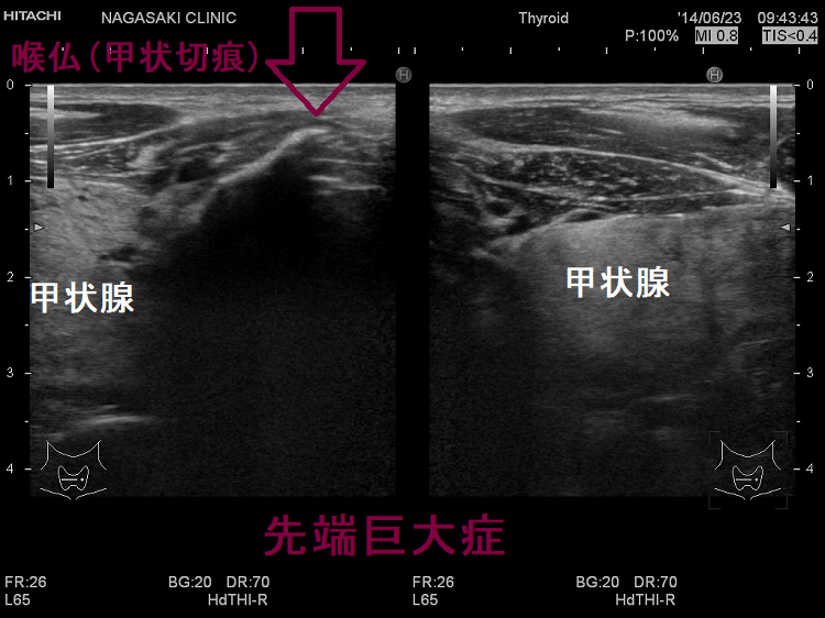 先端巨大症 超音波(エコー)画像 先端巨大症 超音波(エコー)画像