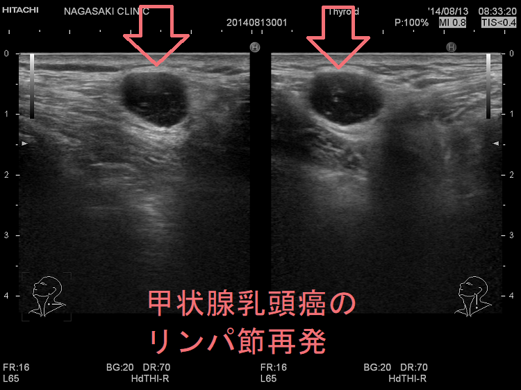 甲状腺癌腫瘍マーカー(サイログロブリン,p53抗体,SCC,CA125,CA19