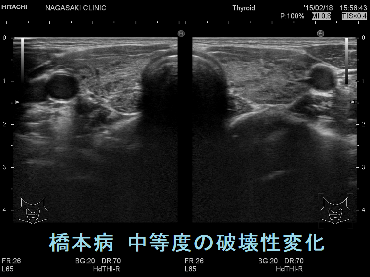 橋本病(慢性甲状腺炎):中等度の破壊 超音波(エコー)画像 橋本病(慢性甲状腺炎):中等度の破壊 超音波(エコー)画像