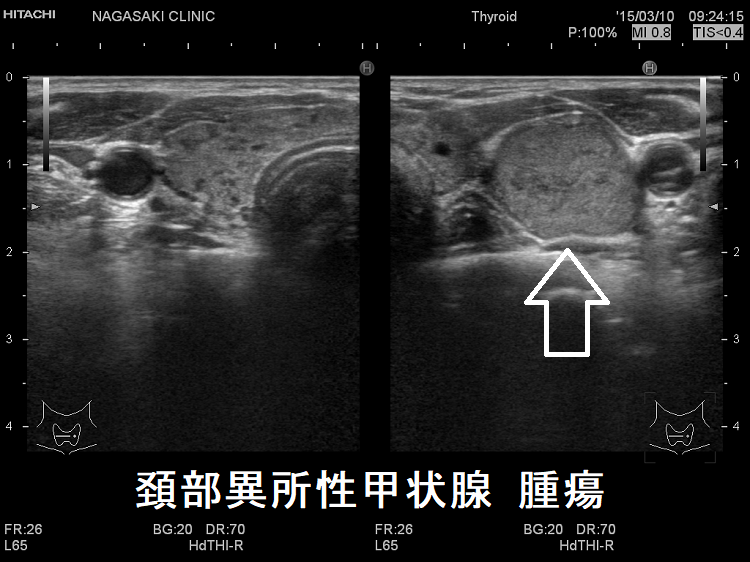 頚部異所性甲状腺 腫瘍 頚部異所性甲状腺 腫瘍