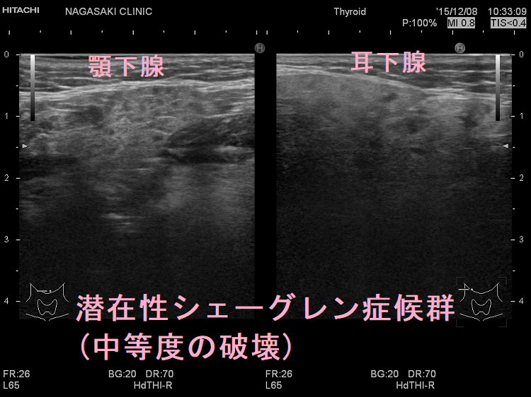 潜在性シェーグレン症候群(中等度の破壊)超音波(エコー)画像 潜在性シェーグレン症候群(中等度の破壊)超音波(エコー)画像