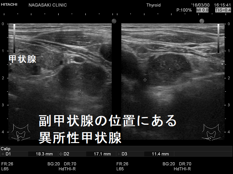 異所性甲状腺 超音波(エコー)画像 異所性甲状腺 超音波(エコー)画像