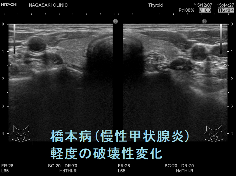 橋本病(慢性甲状腺炎):軽度の破壊 超音波(エコー)画像 橋本病(慢性甲状腺炎):軽度の破壊 超音波(エコー)画像