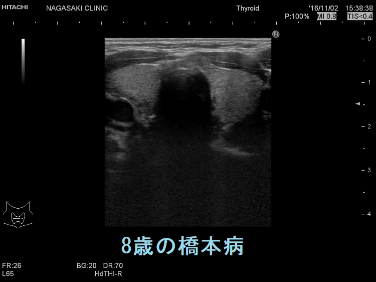 8歳の橋本病 超音波(エコー)画像 8歳の橋本病 超音波(エコー)画像
