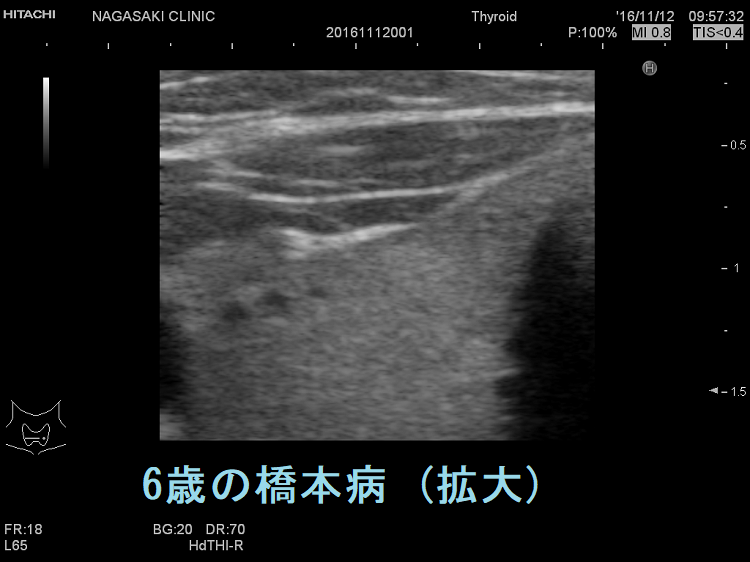6歳女児の橋本病 超音波(エコー)画像 (拡大) 6歳女児の橋本病 超音波(エコー)画像(拡大)