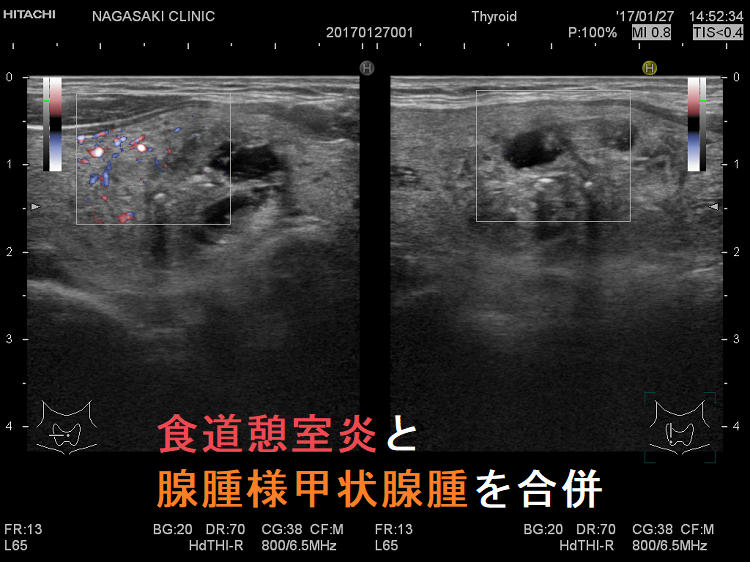 食道憩室炎と腺腫様甲状腺腫を合併した患者の腺腫様結節(ドプラーモード) 食道憩室炎と腺腫様甲状腺腫を合併した患者の腺腫様結節(ドプラーモード)