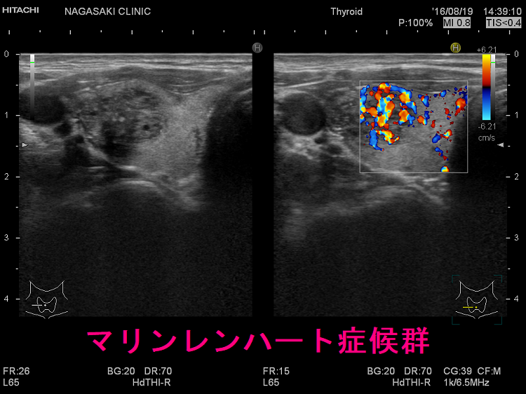 マリンレンハート症候群 超音波(エコー)画像 マリンレンハート症候群 超音波(エコー)画像