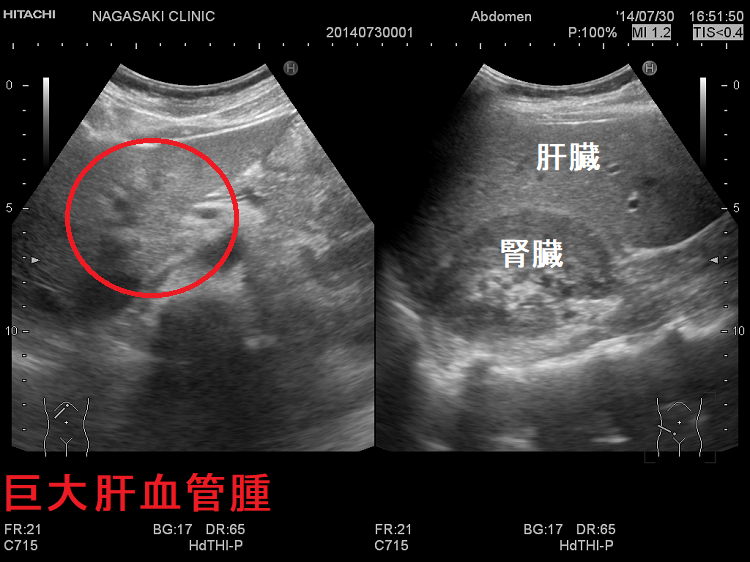 肝血管腫 超音波(エコー)画像 肝血管腫 超音波(エコー)画像
