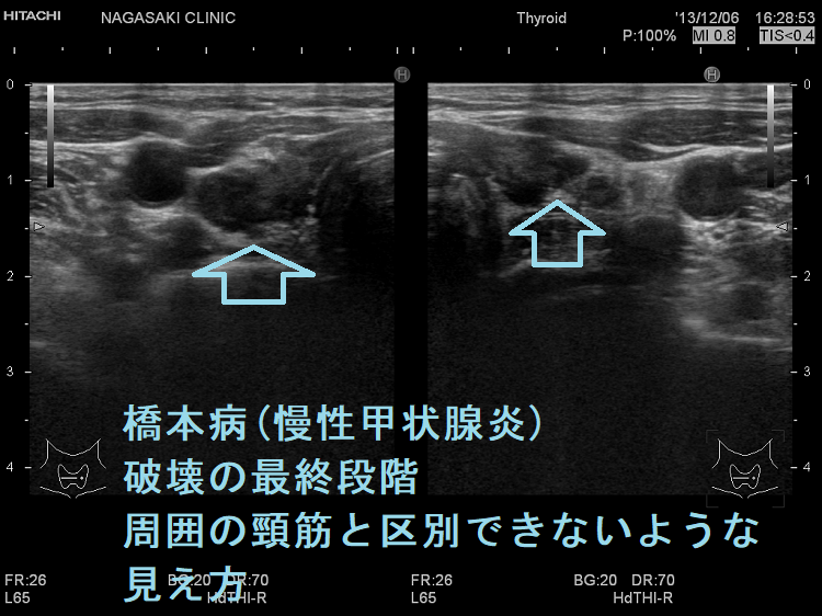 橋本病(慢性甲状腺炎)破壊の最終段階 周囲の頸筋と区別できないような見え方2 橋本病(慢性甲状腺炎)破壊の最終段階 周囲の頸筋と区別できないような見え方2