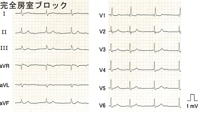 完全房室ブロック 完全房室ブロック