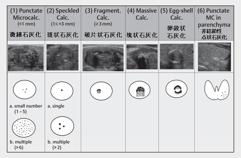 甲状腺乳頭癌の石灰化のパターン 石灰化
