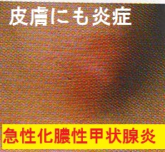 急性化膿性甲状腺炎の皮膚炎 急性化膿性甲状腺炎の皮膚炎