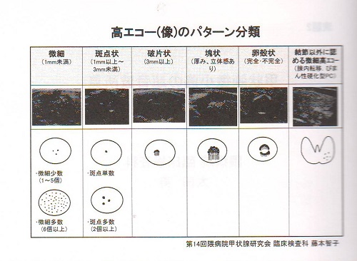 甲状腺乳頭癌の石灰化のパターン 甲状腺乳頭癌の石灰化のパターン