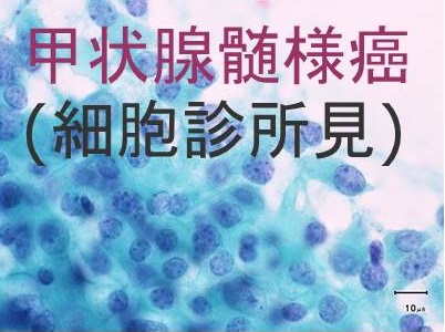 甲状腺髄様癌 細胞診所見 甲状腺髄様癌 細胞診所見