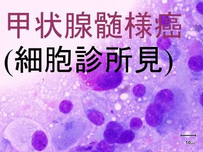 甲状腺髄様癌 細胞診所見 甲状腺髄様癌 細胞診所見