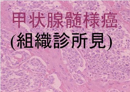 甲状腺髄様癌 組織所見 甲状腺髄様癌 組織所見