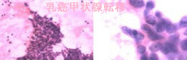 乳癌甲状腺転移細胞診 乳癌甲状腺転移細胞診