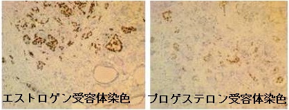 乳癌甲状腺転移 免疫染色 乳癌甲状腺転移 免疫染色