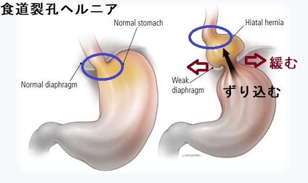食道裂孔ヘルニア 食道裂孔ヘルニア