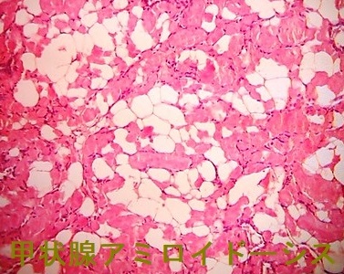 甲状腺アミロイドーシスの組織診 甲状腺アミロイドーシスの組織診
