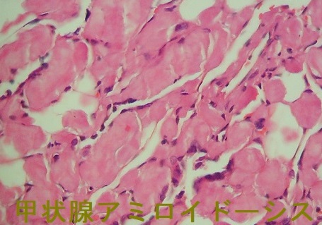 甲状腺アミロイドーシスの組織診 甲状腺アミロイドーシスの組織診