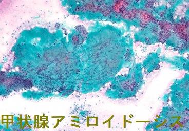 甲状腺アミロイドーシスの細胞診 甲状腺アミロイドーシスの細胞診