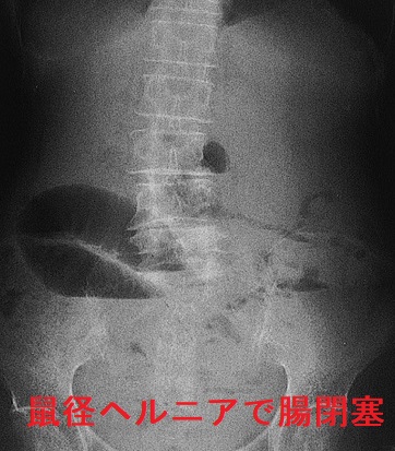 鼠径(そけい)ヘルニア嵌頓 単純X線写真 鼠径(そけい)ヘルニア嵌頓 単純X線写真