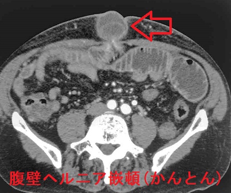 腹壁ヘルニア 嵌頓(かんとん) 腹壁ヘルニア 嵌頓(かんとん)