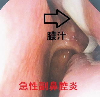 急性副鼻腔炎 鼻腔内視鏡像 急性副鼻腔炎 鼻腔内視鏡像