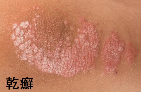乾癬 乾癬
