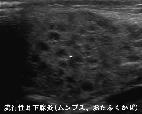 流行性耳下腺炎(ムンプス、おたふくかぜ)超音波(エコー)画像 流行性耳下腺炎(ムンプス、おたふくかぜ)超音波(エコー)画像