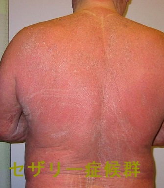 セザリー症候群 セザリー症候群