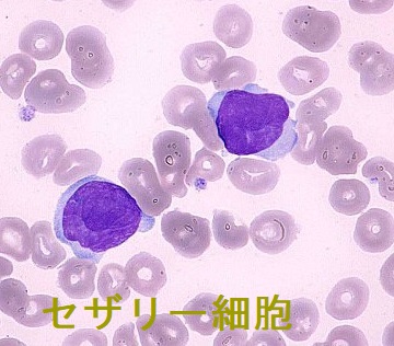 セザリー細胞 セザリー細胞