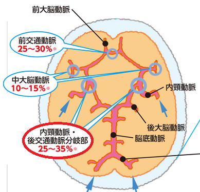 内頸-後交通動脈瘤で視神経圧迫 内頸-後交通動脈瘤で視神経圧迫
