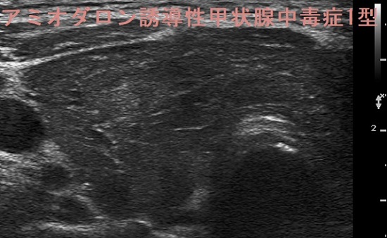 アミオダロン誘発性甲状腺中毒症I 型 超音波(エコー)画像 アミオダロン誘発性甲状腺中毒症I 型 超音波(エコー)画像