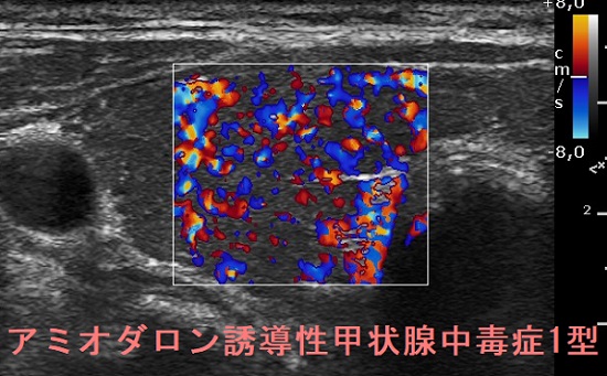 アミオダロン誘発性甲状腺中毒症I 型 超音波(エコー)画像 ドプラー アミオダロン誘発性甲状腺中毒症I 型 超音波(エコー)画像 ドプラー